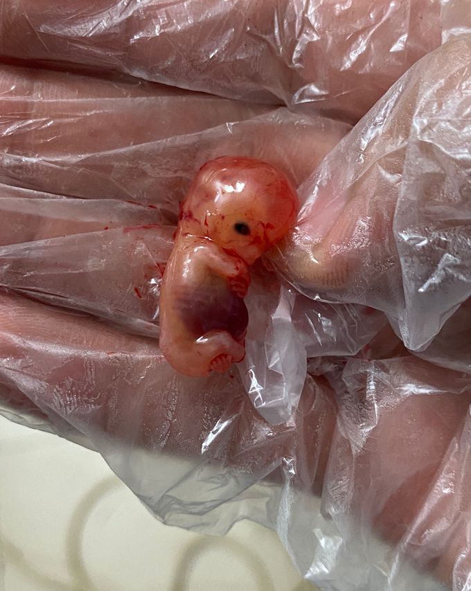 11 weeks old fetus