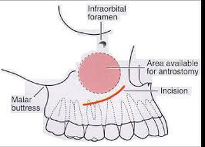 The Caldwell-luc Procedure