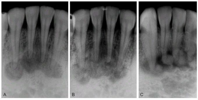 Periapical cemento-osseous dysplasia.
