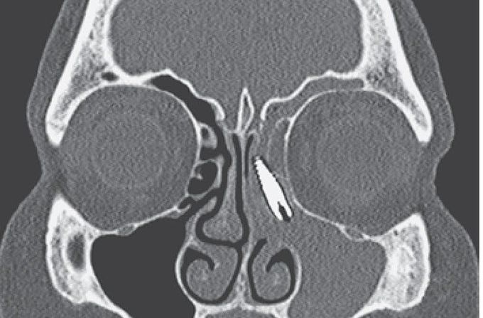 Dental implant in the sinus