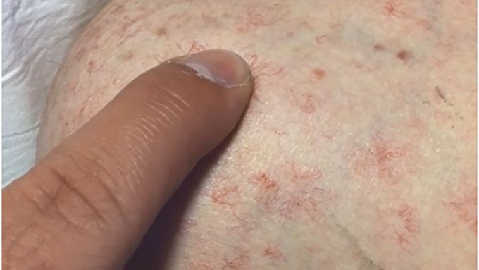 How is spider nevus diagnosed?