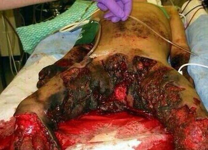 ⚠️ Injured After a Land Mine Exploded ⚠️
