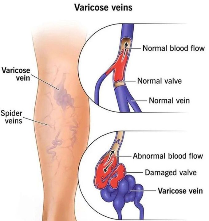 Varicose Veins