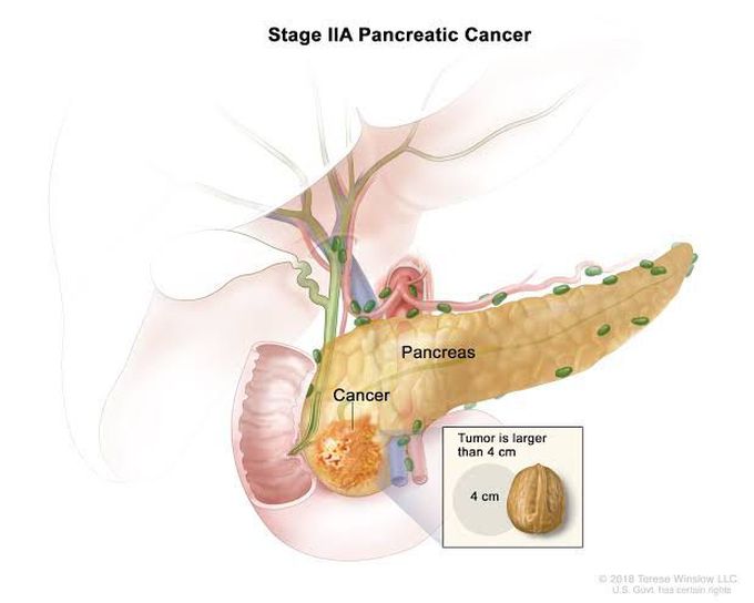 Treatment of pancreatic cancer