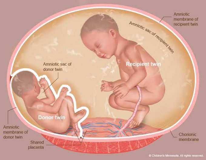 Twin twin transfusion syndrome causes