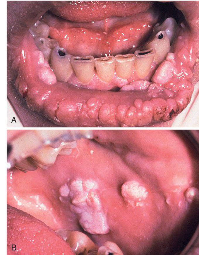 HIV-associated Human Papillomavirus (HPV) Infection