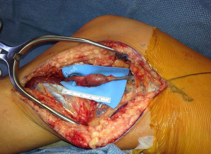 Popliteal aneurysm