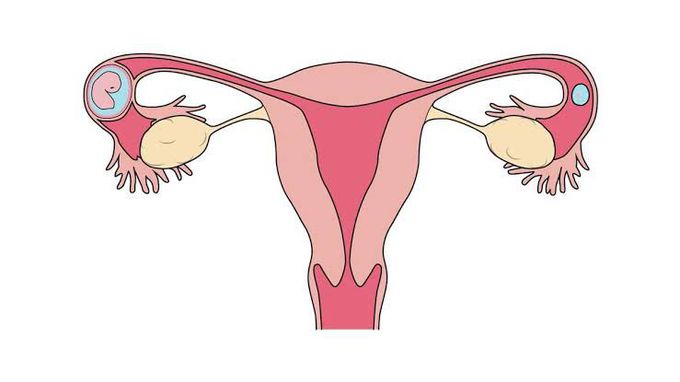 Ectopic pregnancy