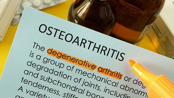 Osteoarthritis Cases Projected to Balloon Over Next 30 Years