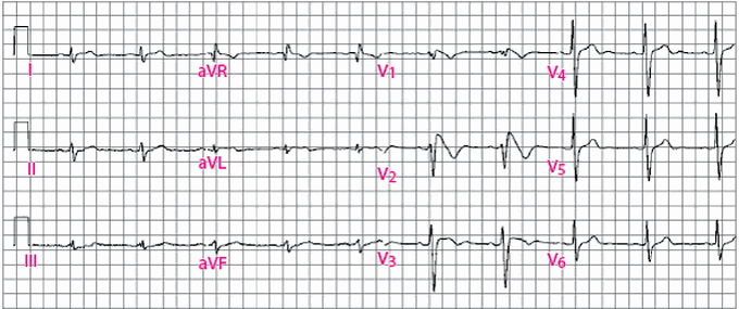 Brugadas syndrome