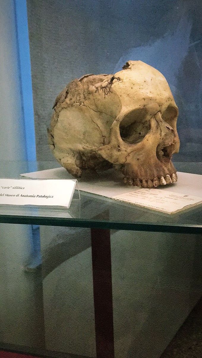 Skull in a man with syphilis 😷
