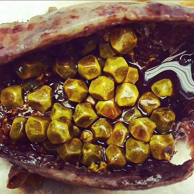 Gallstones