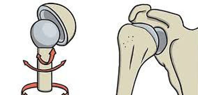 Ball and socket joint - MEDizzy