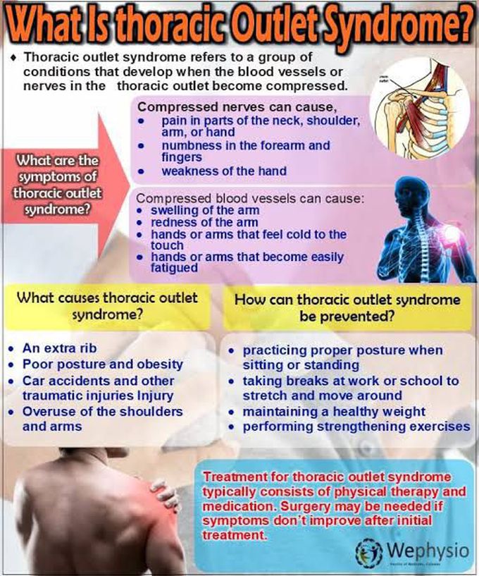 Thoracic Outlet Syndrome