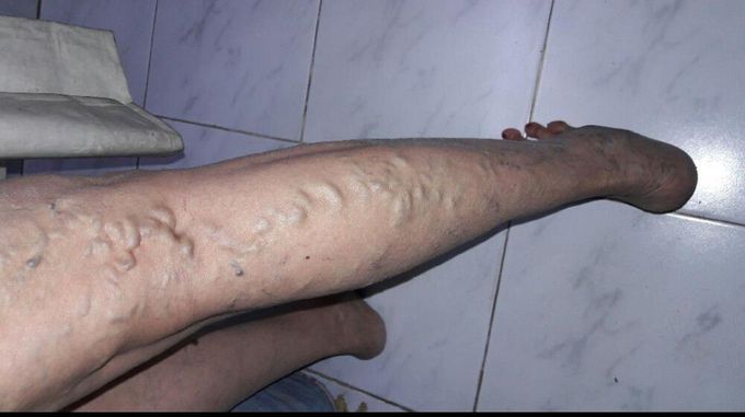 Varicose vein