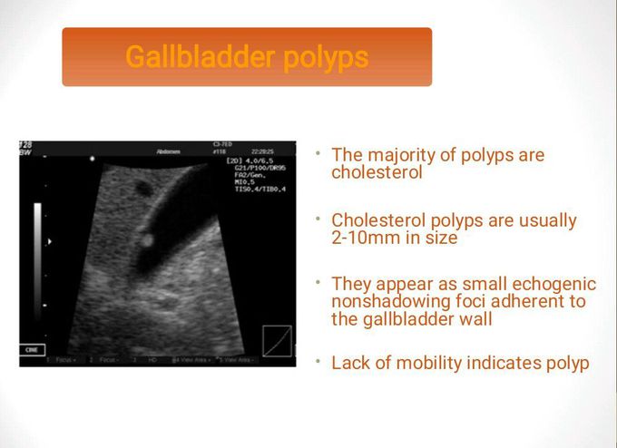 Gallbladder Polyps