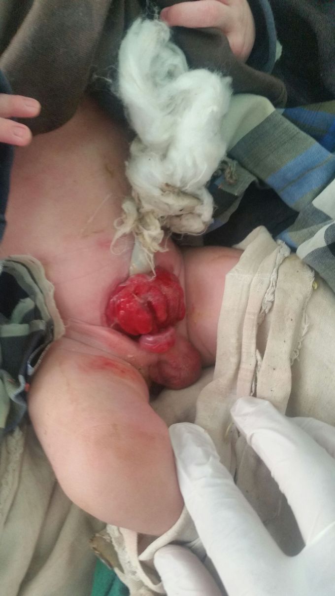 Congenital anomalies