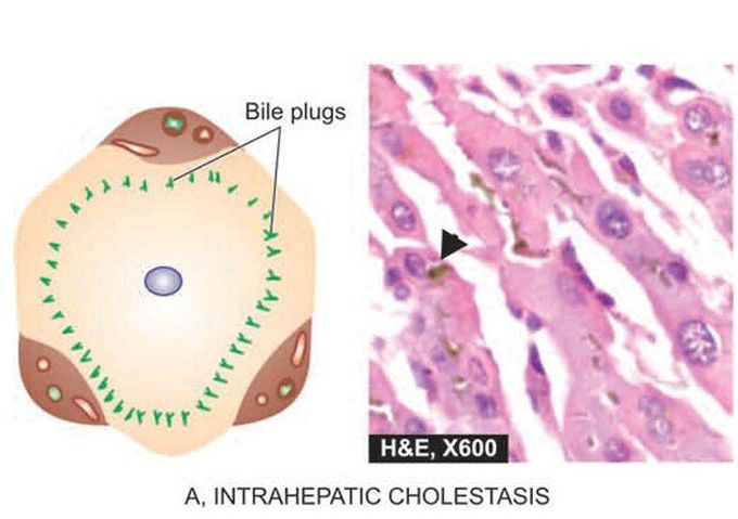 Salient features in morphology of liver in intrahepatic cholestasis