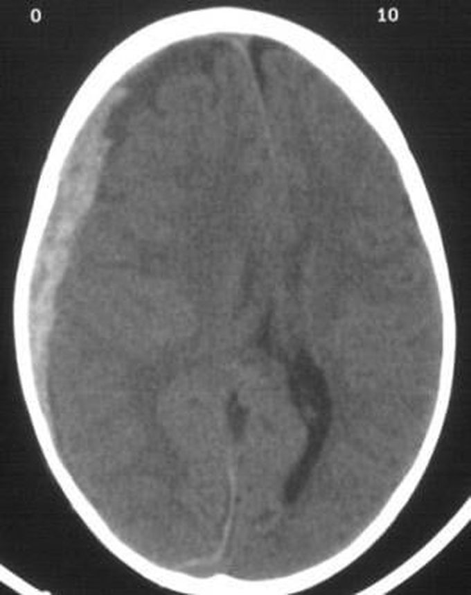 Subdural hematoma MEDizzy
