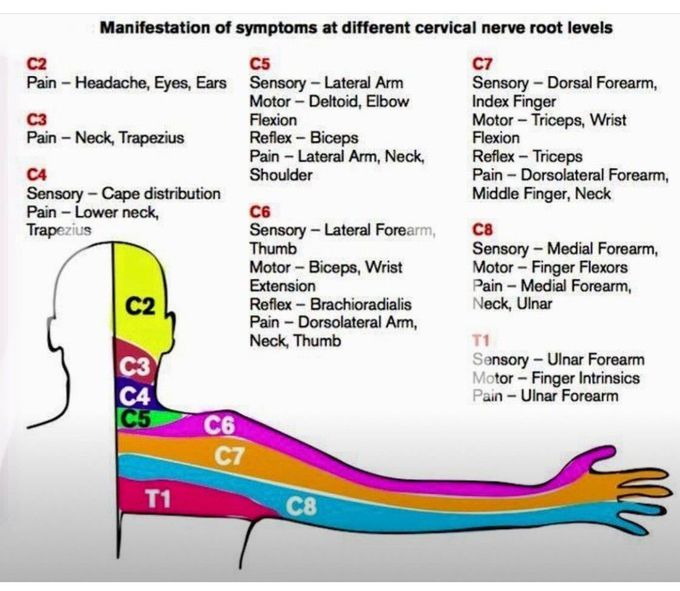 Cervical Nerve Roots- Symptoms