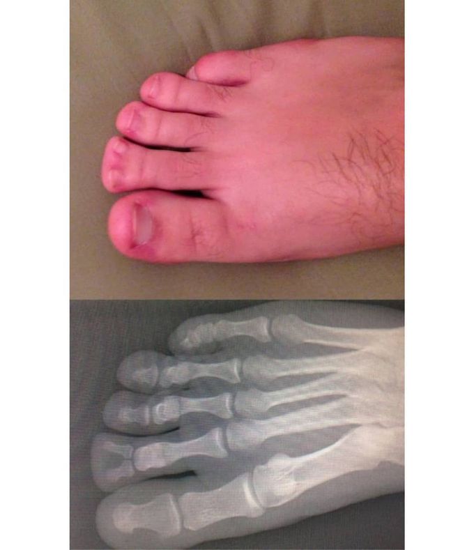 Polydactyly