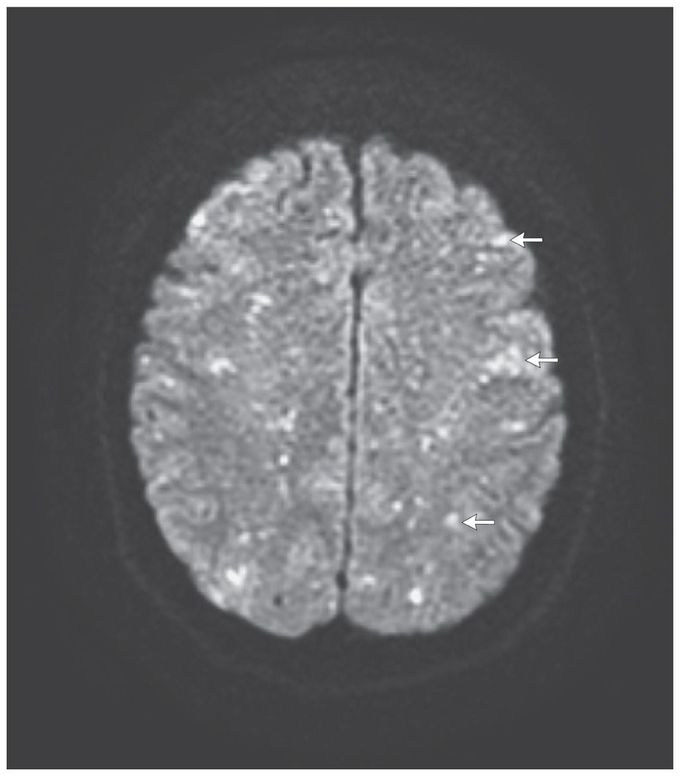 Cerebral Fat Embolism