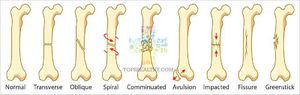 Types of fracture - MEDizzy