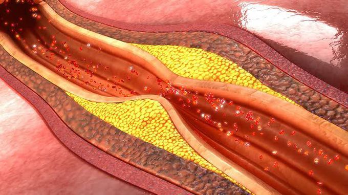 ATHEROSCLEROSIS