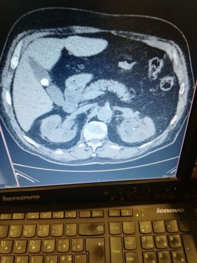 Any comment about the finding plz?? The ot pressent with flank pain and he has UTI.