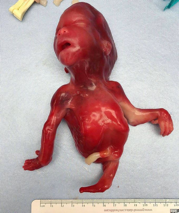 A fetus with Sirenomelia, or mermaid syndrome!