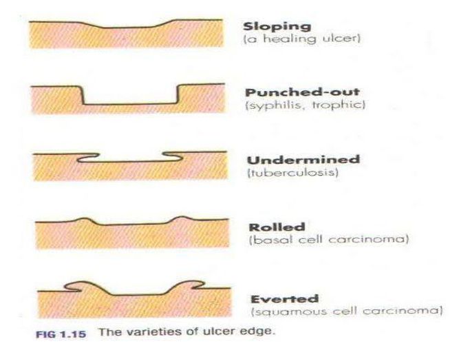 Ulcer edges