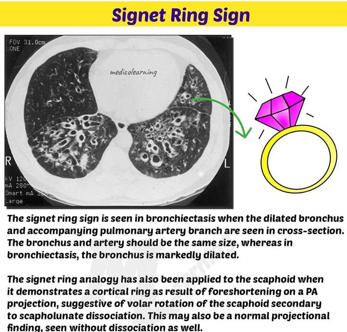 Ring sign