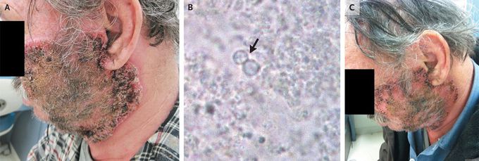 Cutaneous Blastomycosis