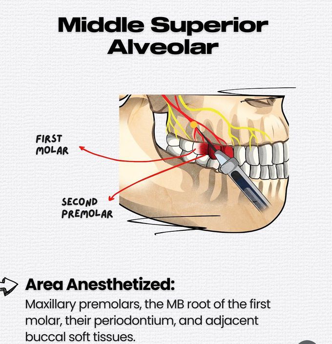 Maxillary Local Anesthesia VI