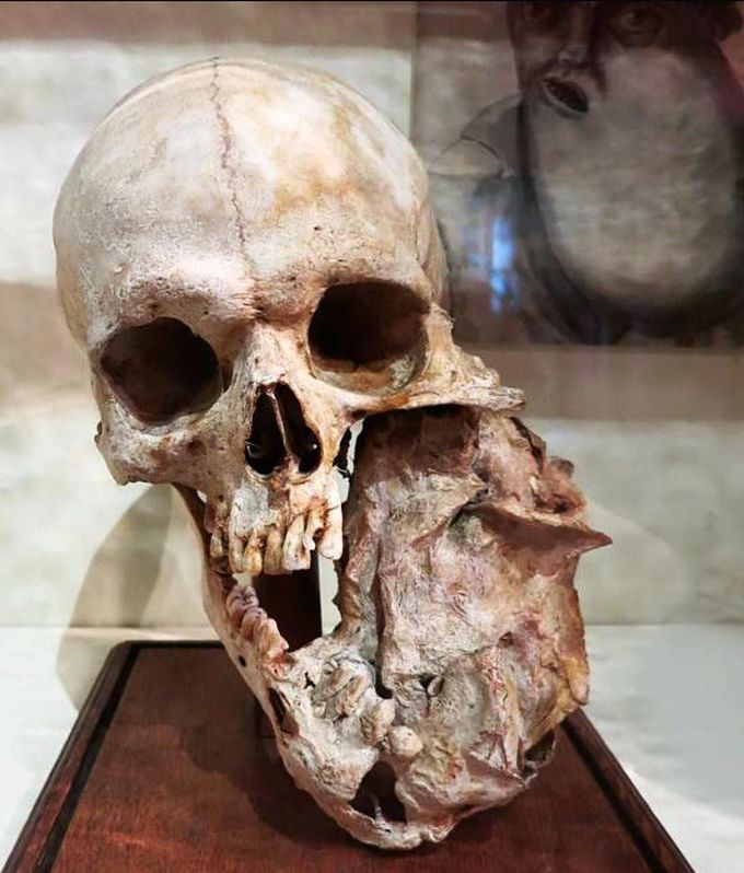 Mandibular tumor