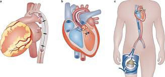 Causes of cardiogenic shock