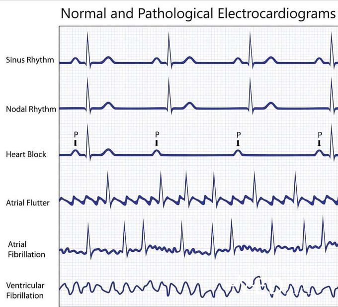 ECG Abnormalities....