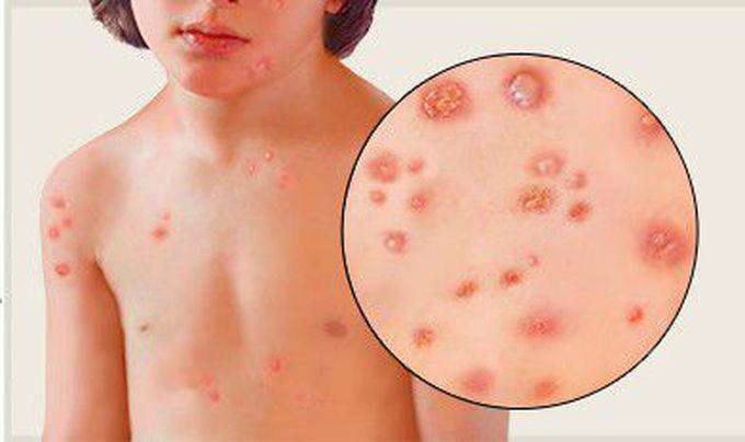 Chickenpox