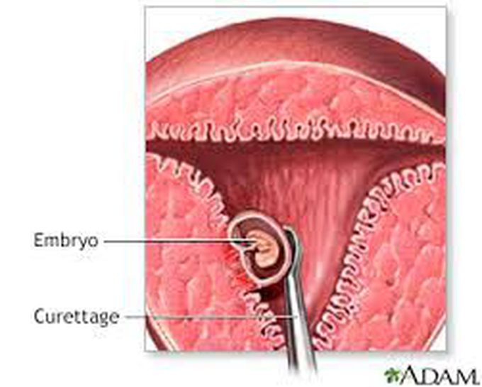 What is a medical abortion?