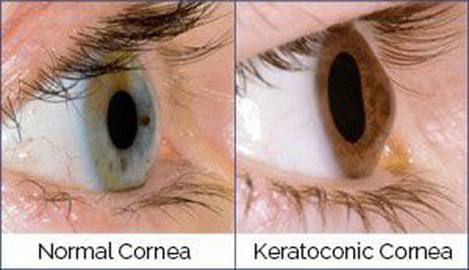 Keratoconus