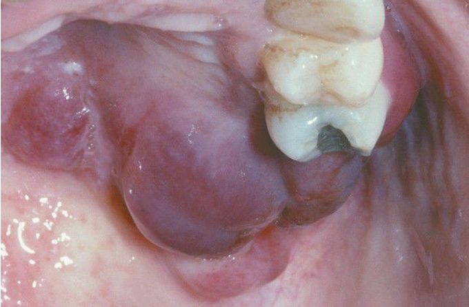 HIV-associated Kaposi Sarcoma (KS).