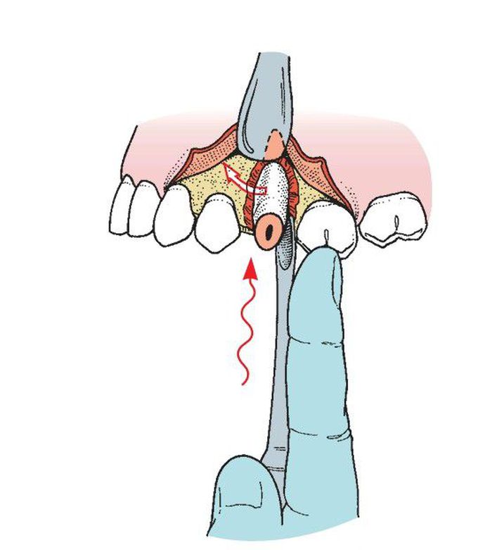 Luxation of root