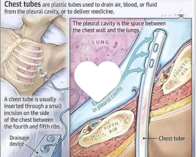 Chest Tubes