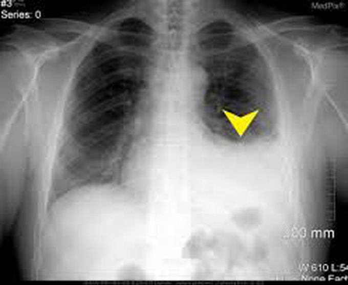 Hemothorax treatment