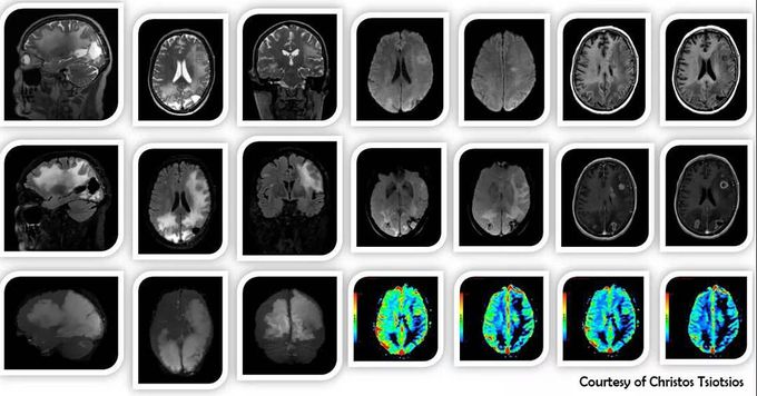 MR Imaging of glioblastoma multiforme, based on volumetric acquisitions