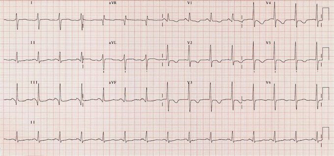 54 yr old male pt,with chest pain and breathlessness...no - MEDizzy