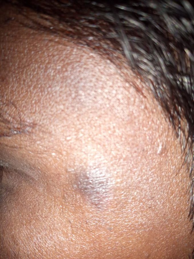What is this....a black itching spot around eye on cheeks from last months..pls diagnose& treatment please?