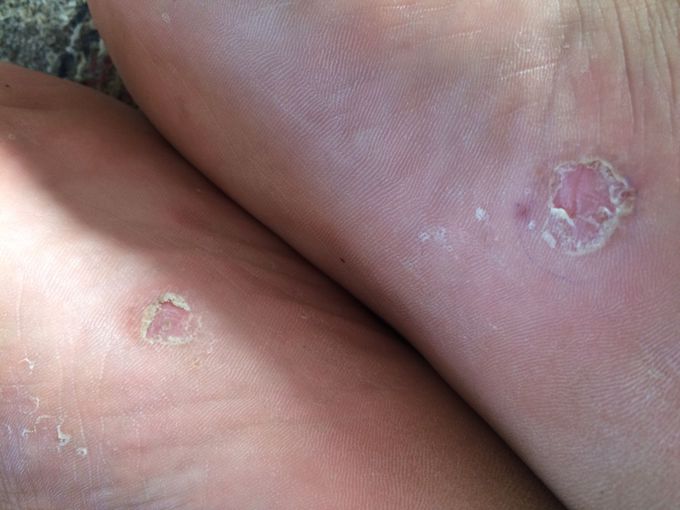 Very itchy... diagnosis???