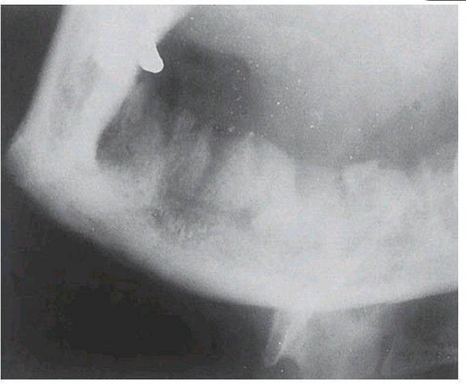 Osteomyelitis