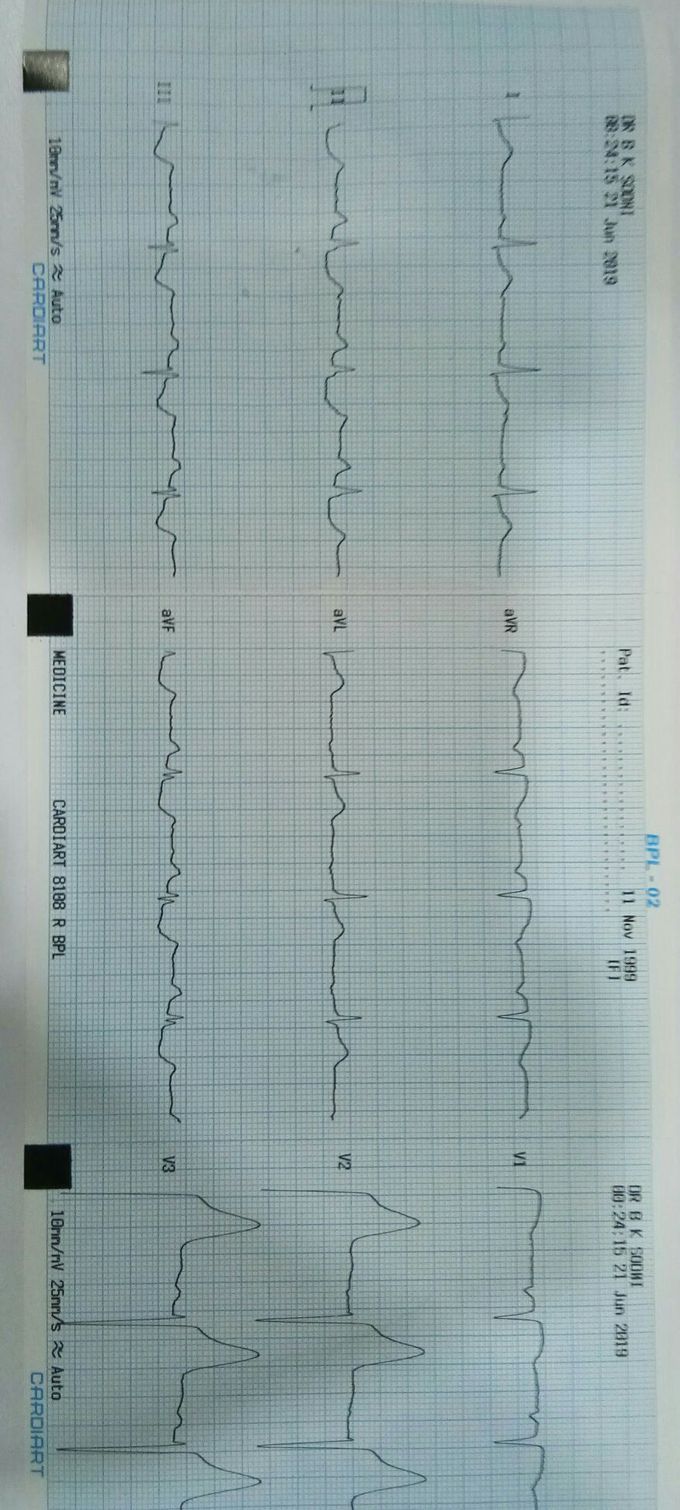 ECG diagnosis